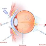 Exploring the Potential of Nanoparticles in Ocular Drug Delivery