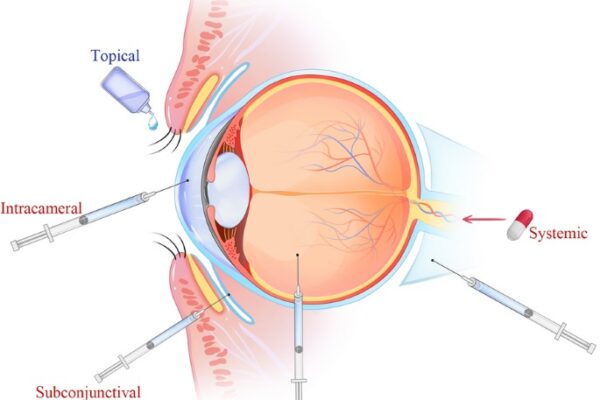 Exploring the Potential of Nanoparticles in Ocular Drug Delivery